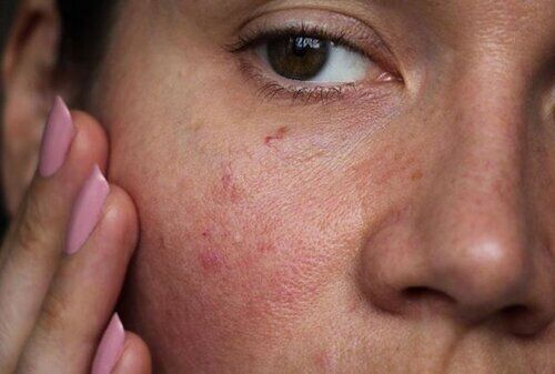 peau grasse acne.jpg